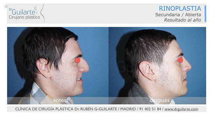 resultados rinoplastia