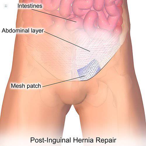 hernia inguinal