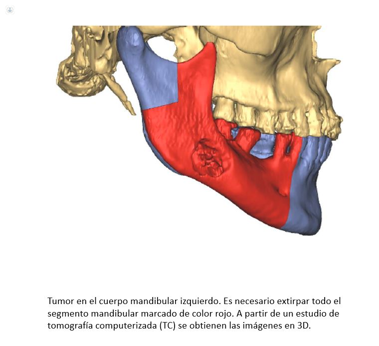 tumor mandibula