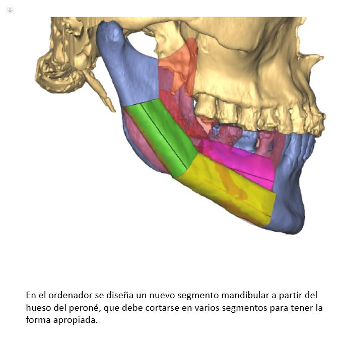 tumor mandibular