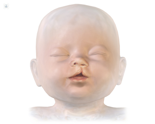 labio leporino niños