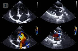 ecocardiograma soplos