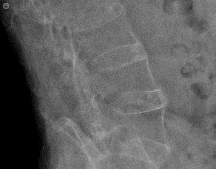 Radiografía de columna lumbar donde se aprecia la soldadura entre vertebras en un paciente con espondilitis avanzada.