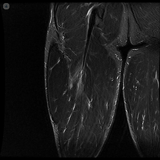 rotura fibrilar biceps femoral