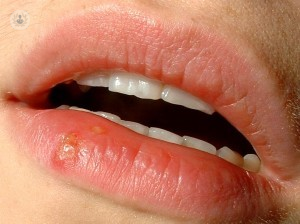Cancer oral