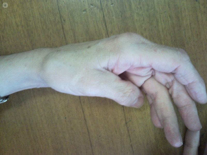 Rizartrosis o artrosis del pulgar. Síntomas, tratamiento y