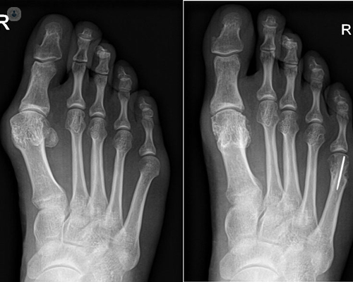 When you operate bunion | Top Doctors