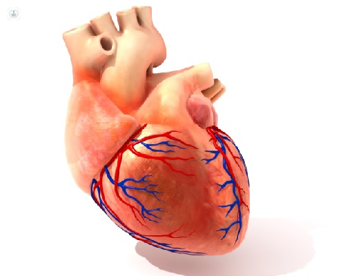 infarto de miocardio