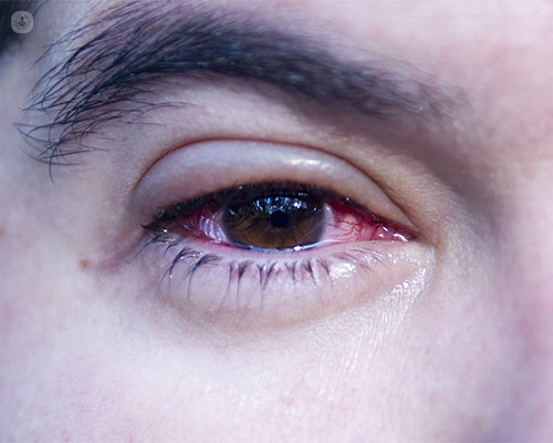 ojos llorosos blefaritis - Top Doctors